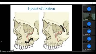 Oral amp Maxillofacial Surgery Part 3 Management of Facial bone Fractures5 dentist bds [upl. by Karia619]