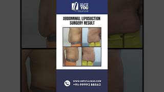 Abdominal Liposuction Surgery BeforeAfter Results  Liposuction Surgeon In Delhi  Dr PK Talwar [upl. by Ailsun728]