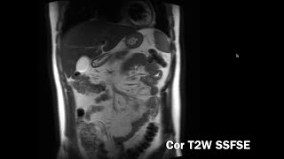 Introduction to Abdominal MRI Background Pulse Sequences Normal Appearance Body MRI Abdo MRI [upl. by Bordie]