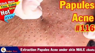 Extraction Papules Acne under skin MALE clients  Acne Treatment 116 [upl. by Schnurr]