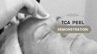 35 TCA peel demonstration [upl. by Darrelle]