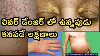 Symptoms of Liver Disease in Telugu  కాలేయ వ్యాధి లక్షణాలు [upl. by Adnov]