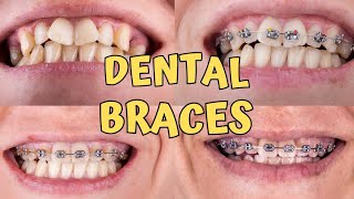 Braces time lapse  Teeth braces treatment  braces teeth transformation [upl. by Novaj430]