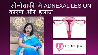 सोनोग्राफी में ADNEXAL LESION कारण और इलाज [upl. by Beffrey272]