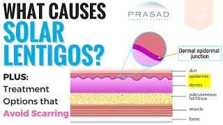 Causes and Treatments for Solar Lentigos [upl. by Doscher]