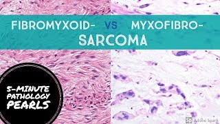 FIBROmyxo vs MYXOfibro Sarcoma Made Simple 5Minute Pathology Pearls [upl. by Lilla]