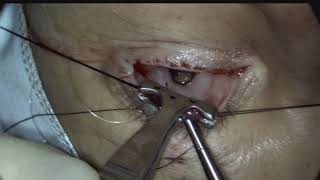 Posterior approach ConjunctivalMullers resection ptosis surgery Putterman procedure [upl. by Ayadahs]