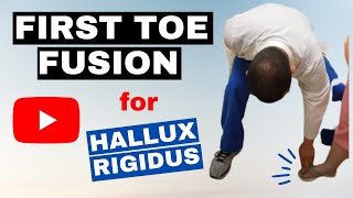 First toe fusion for hallux rigidus [upl. by Yllen]