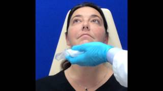 Kybella treatment [upl. by Steiner209]