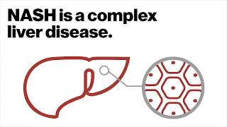 Multipronged approach for complex liver disease [upl. by Mountfort]