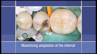 Posterior Restoration How to use a Flowable Restorative as a Liner in a Class II Dental Restoration [upl. by Mahalia32]