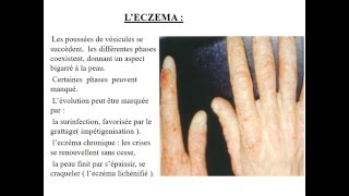 MEDECINE DU TRAVAIL CAT devant une dermatose professionnelle Dermite de contact [upl. by Ayyidas]