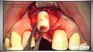 Allograft Bone Ring Augmentation 2 [upl. by Adner]