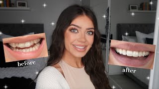 MY TEETH JOURNEY QampA  Invisalign amp Composite Bonding [upl. by Atteirneh]