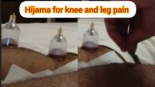 جلسة حجامة لألم الركبة و الساق hijama for knee and leg pain asmr massage wet cup therapy [upl. by Aimej]