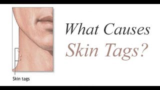 What Causes Skin Tags [upl. by Benni]