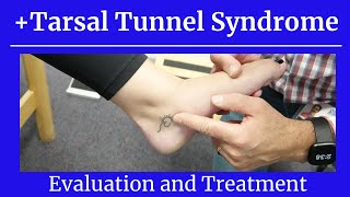 Positive Tarsal Tunnel SyndromeEval and Treatment [upl. by Boycey]