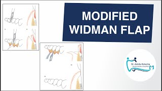 MODIFIED WIDMAN FLAP OPEN FLAP CURETTAGE  PERIODONTAL SURGICAL TECHNIQUE DR ANKITA KOTECHA [upl. by Esydnac]