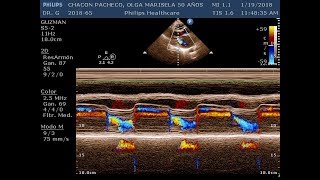 Doble Lesión Mitral reumatica [upl. by Nangatrad34]