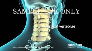 Lumbar Laminectomy [upl. by Kiraa]