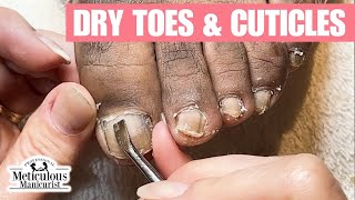 Discolored Dry Toenails Transformation [upl. by Warwick]