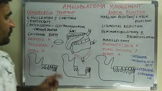 Ameloblastoma management [upl. by Lraep]