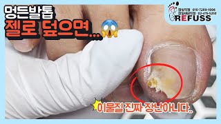 1년전 멍든발톱 젤로 덮으니 균성발로 변형😣 발톱 발관리 박리 레푸스 toenail refuss [upl. by Selohcin]