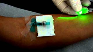 Intravenöse Laserblutbestrahlung mit dem Weberneedle® Endo Laser [upl. by Dunlavy]