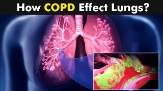 Chronic Obstructive Pulmonary Disease COPD  Symptoms Causes And Treatment UrduHindi [upl. by Enilarac631]