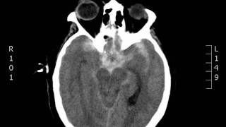 Subarachnoid Hemorrhage CT JETem 2017 [upl. by Soluk]