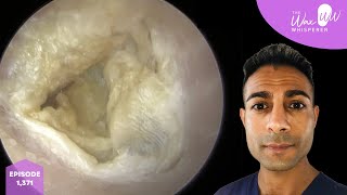 1371  Typical Ear Wax Removal amp Dead Skin Peel Clinic 9 Procedures [upl. by Akimahs205]