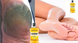 This Listerine amp Vinegar Foot Soak is Magic for Dry Heels GET RID OF DRY SCALY FEET [upl. by Heaps]