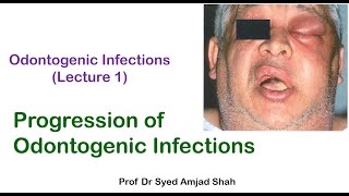 Progression of Odontogenic Infections  Oral amp Maxillofacial Surgery  Syed Amjad Shah [upl. by Dollie454]