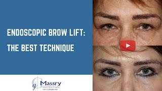 Endoscopic Brow Lift Video  Before amp After Brow Lift [upl. by Erika]