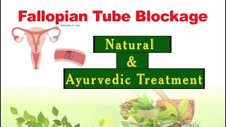 Fallopian Tube Blockage Treatment With Natural amp Ayurvedic Medicines  गर्भाशय की बंद नली का उपचार [upl. by Dora]