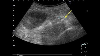 Ureteral Stones [upl. by Ellemaj208]