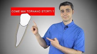 Come lapparecchio allinea i denti e perché tornano storti [upl. by Thedrick973]