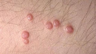 DermTV  Molluscum Contagiosum DermTVcom Epi 445 [upl. by Karen]