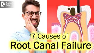 What are different reasons for a Root Canal failure Failed root canalDr Hussain Iqbal Wardhawala [upl. by Garrott]