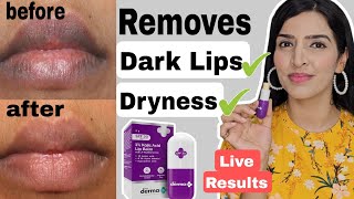 Derma co Kojic acid Lip Balm Review  Reduces Lips Pigmentation Dryness chappy lips darklips [upl. by Inalak618]