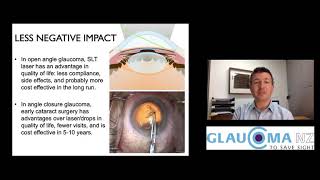 Dr Jesse Gale  Future Directions in Glaucoma [upl. by Anelys]