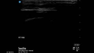 Rib Ultrasound Subluxation at the Costochondral Junction Short Axis [upl. by Haseena407]