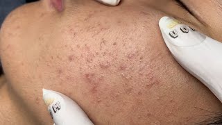 ACNE TREATMENT VU QUYNH MI Acne On Teens Cheek 2024 [upl. by Ramalahs621]