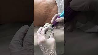 Stretch Marks Inkless Removal Boleyn Treatment Los Angeles 🌍 shorts [upl. by Awhsoj]