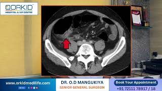 How Appendix treatment is done  Appendix Treatment at low cost  Senior most Surgeon in Gujarat [upl. by Nnairac89]