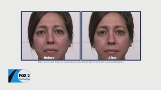 Smooth out your fine lines with Plexaderm for only 1495 [upl. by Handel162]