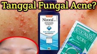 MABISANG PANTANGGAL NG TIGYAWAT SA NOO O FUNGAL ACNE  TREAT FUNGAL ACNE WITH NIZORAL SHAMPOO [upl. by Seraphim]