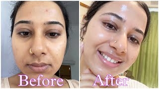 Dermatologist recommended Best 2 Cream under Rs 300 that has changed my skin  Best pharmacy cream [upl. by Rehpotsirhcnhoj164]