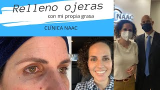 RELLENO DE OJERAS CON MI PROPIA GRASA [upl. by Nera]