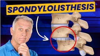 Spondylolisthesis 4 Exercises to Reduce Pain Demo on Real Patient [upl. by Milissent]